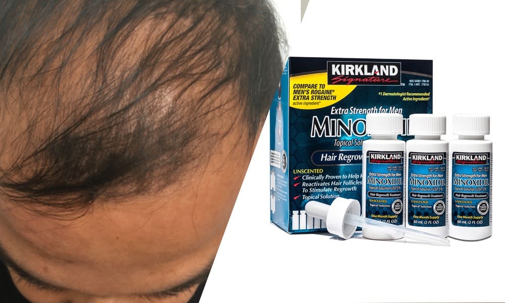 Кожа головы с редеющими волосами рядом с упаковкой Minoxidil Kirkland